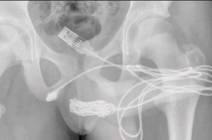 Joven se introduce un cable USB en el pene y termina en el hospital